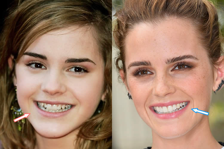 Emma Watson v dospělosti a dospívání